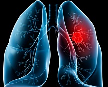 Lung Cancer E-Cigs